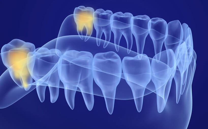 Wisdom Teeth Removal Anesthesia