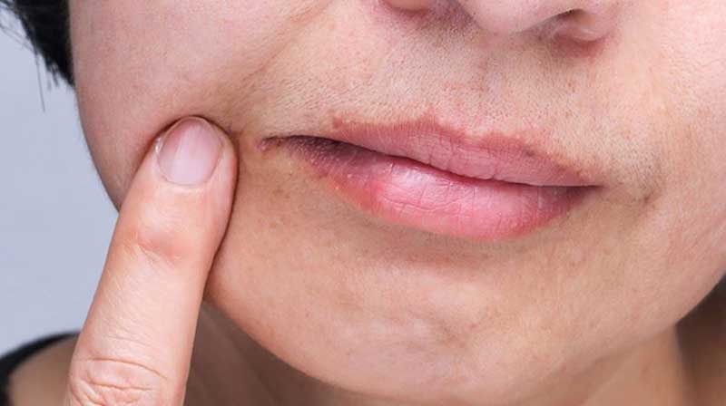 Cheilosis/Cheilitis: Causes, Symptoms, Diagnosis and How to Treat