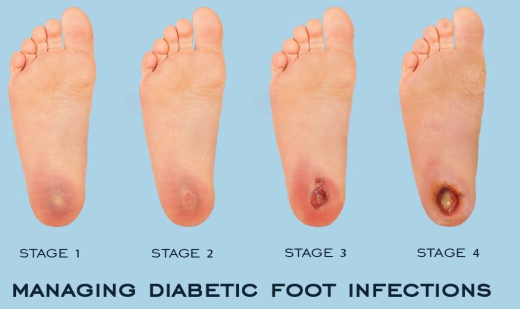 Spot The Signs Of A Diabetic Ulcer On The Foot