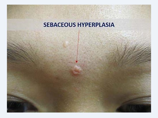 Causes of Sebaceous Hyperplasia