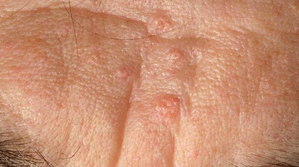 Sebaceous Hyperplasia Treatment and Home Remedies