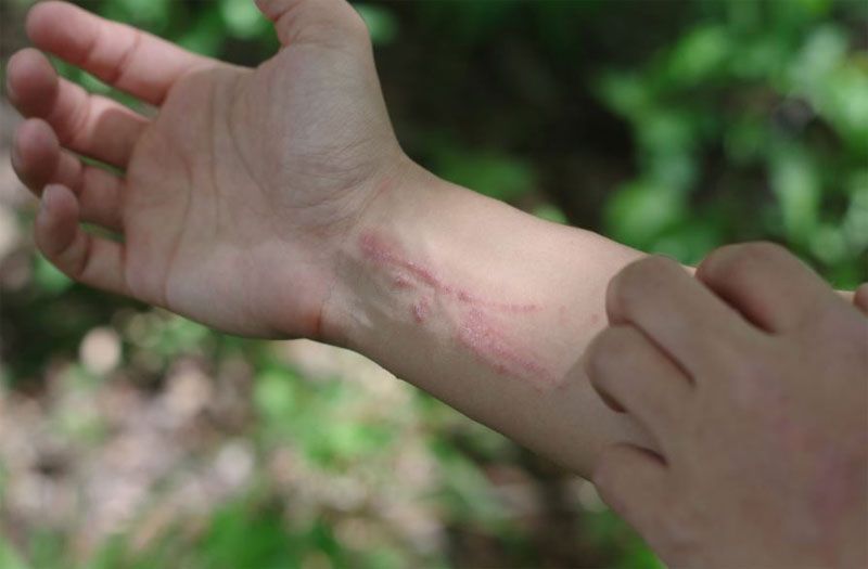 Ways on How to Treat Poison Ivy