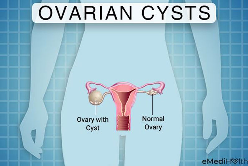 What Causes Ovarian Cysts