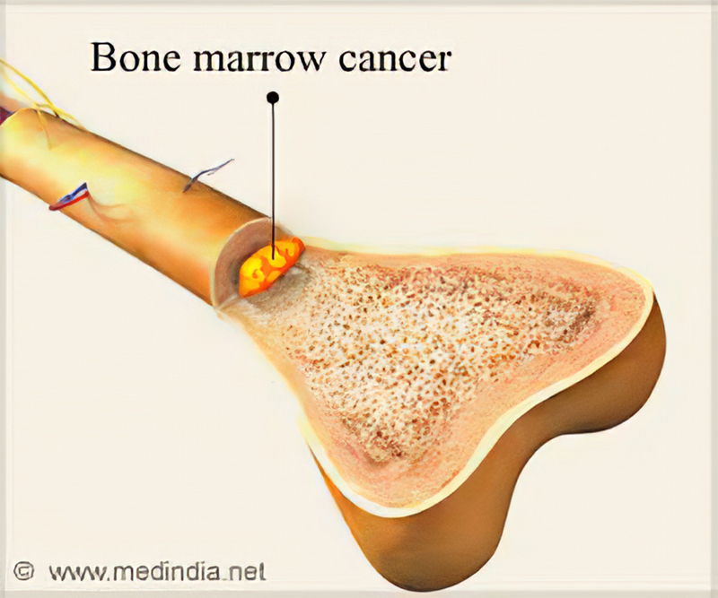 All About Bone Marrow Diseases