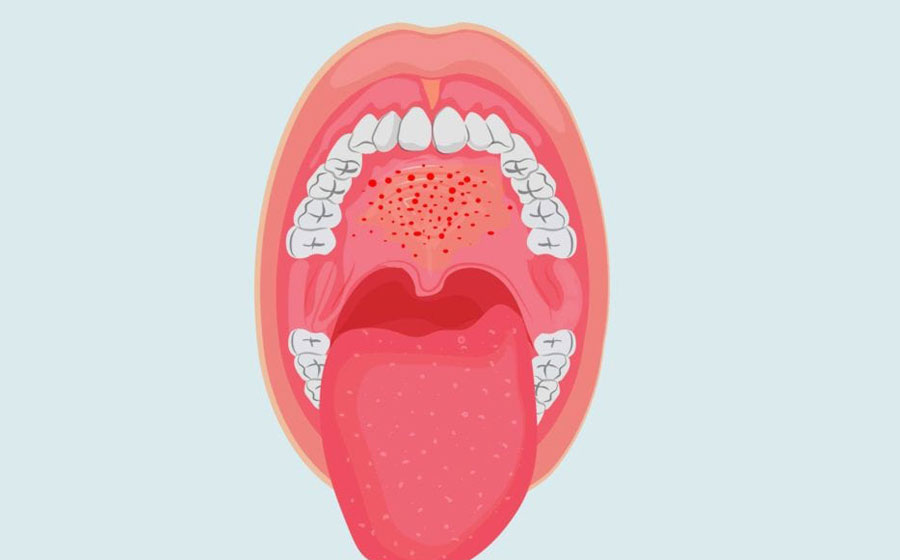Is the Roof of Your Mouth Painful or Sore?
